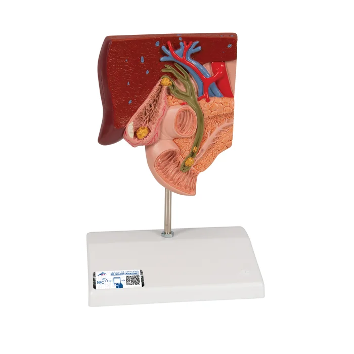 Gallensteinmodell – 3B Smart Anatomy