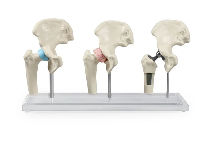 Hüft-Implantat-Modell
